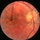 Rubella retinopathy Rubella retinopathy