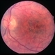 Rubella retinopathy Rubella retinopathy