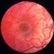 Rubella retinopathy 2 Rubella retinopathy 2