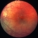 Rubella retinopathy 2 Rubella retinopathy 2