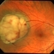 Choroidal melanoma case 4 - partly amelanotic Choroidal melanoma case 4 - partly amelanotic
