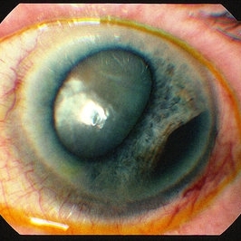 Ocular melanoma - Retina Image Bank