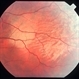 Commotio retinae Commotio retinae