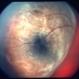 Choroidal melanoma case 2 image 2 Choroidal melanoma case 2 image 2