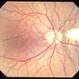 Angioid streaks - PXE Angioid streaks - PXE