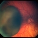Choroidal melanoma 1 - colour photo Choroidal melanoma 1 - colour photo