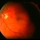Congenital retinal macrovessel Congenital retinal macrovessel