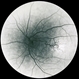 Congenital retinal macrovessel Congenital retinal macrovessel