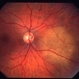 Choroidal metastasis case 2 image 1 Choroidal metastasis case 2 image 1