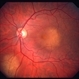 Choroidal metastasis case 2 image 2 Choroidal metastasis case 2 image 2