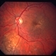 Choroidal metastasis case 2 image 3 Choroidal metastasis case 2 image 3
