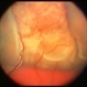 Choroidal metastasis case 3 image 1 Choroidal metastasis case 3 image 1