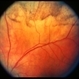 Choroidal metastasis case 3 image 2 Choroidal metastasis case 3 image 2
