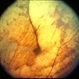 Choroidal metastasis - case 3 image 3 Choroidal metastasis - case 3 image 3