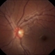 Remnant of Hyaloidal Artery Remnant of Hyaloidal Artery