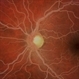 'Salmon-Pink' Fundus in Hypertriglyceridemia 'Salmon-Pink' Fundus in Hypertriglyceridemia