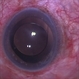 Giant Retinal Tear After Buckle With Perfluorocarbon Liquid