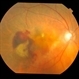 Advanced wet AMD