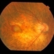 Myopia Associated CNVM