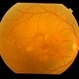 Chronic Atypical CSCR
