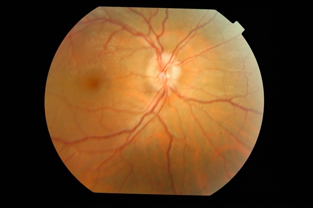 Papilledema Mild - Retina Image Bank