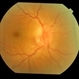 Anterior Ischaemic Optic Neuropathy