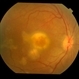 Tubercular choroidal granuloma