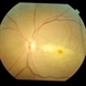 Central retinal artery occlusion