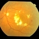 Diabetic Macular Edema