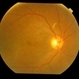 chronic central serous chorioretinopathy