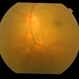 Sarcoidosis