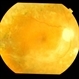 Macular Traction in  PDR