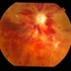 Ischaemic CRVO
