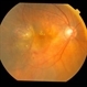 Advanced Wet AMD