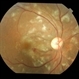 SLE retinopathy