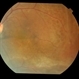 Retinoschisis