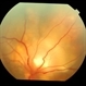 Blastomycosis