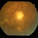 Tubercular choroidal granuloma