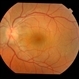 Papilledema