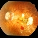 High Myopia with CNVM