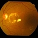 Foveal Exudates in Diabetic Maculopathy