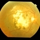 Exudative AMD