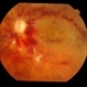 Ischaemic CRVO
