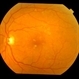 Diabetic Maculopathy