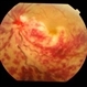 Inflammatory Retinal Vein Occlusion