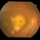 Tubercular choroidal granuloma