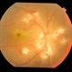 endogenous endophthalmitis following meningitis