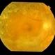 Macular Traction in  PDR