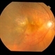 Advanced Wet AMD