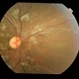 SLE retinopathy